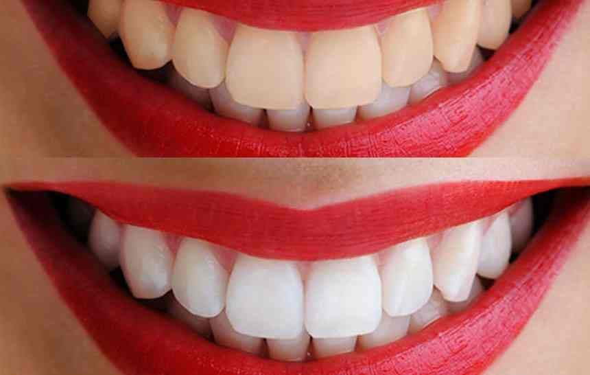 blanqueamiento dental qué es