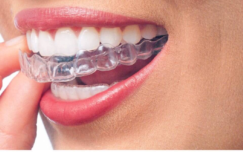 invisalign en Vigo