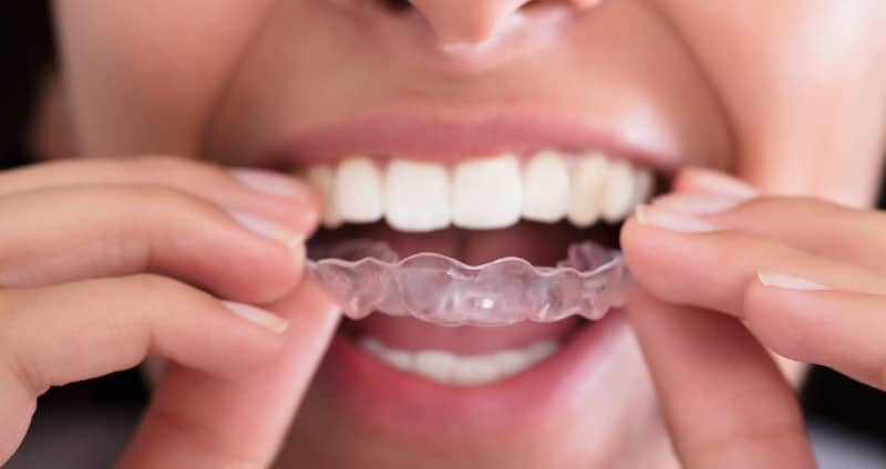 Invisalign en Vigo: Ortodoncia invisible
