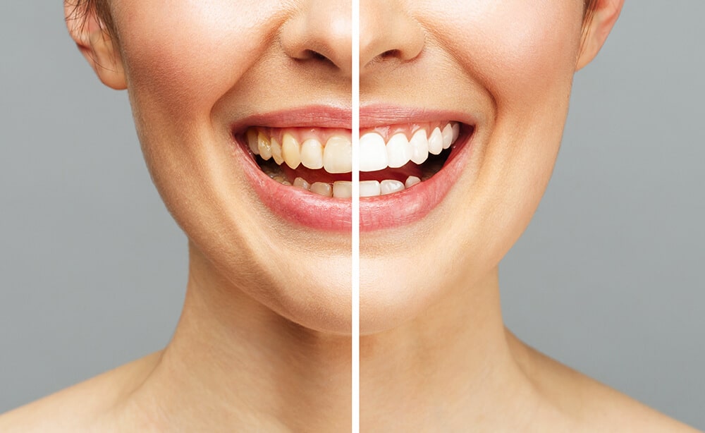 tipos de blanqueamiento dental profesional