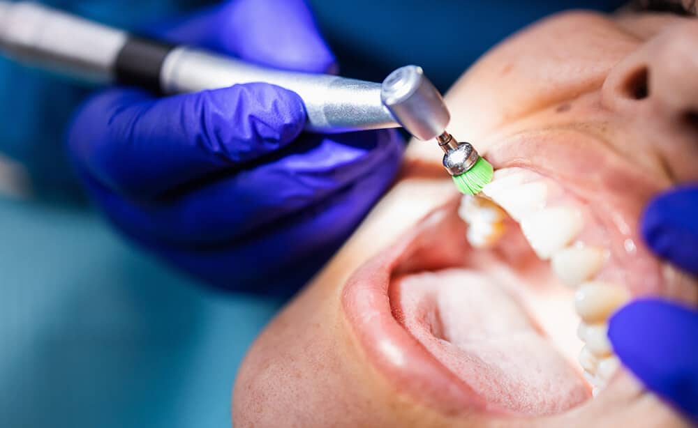 tartrectomía dental qué es