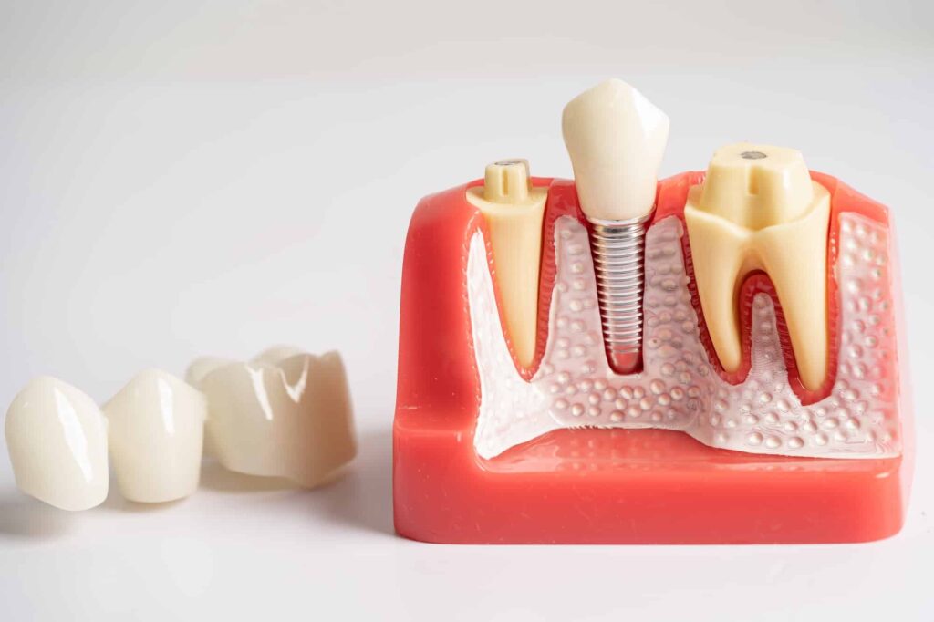 tratamiento de implantes dentales